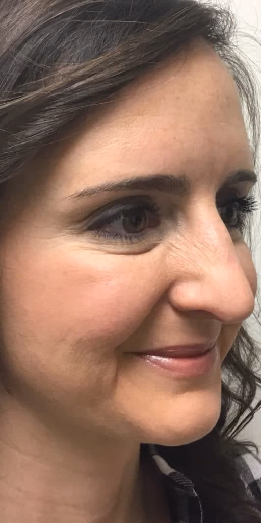 Botox before and after, Olivia Salmen, case 9740 - Cool Springs Plastic Surgery