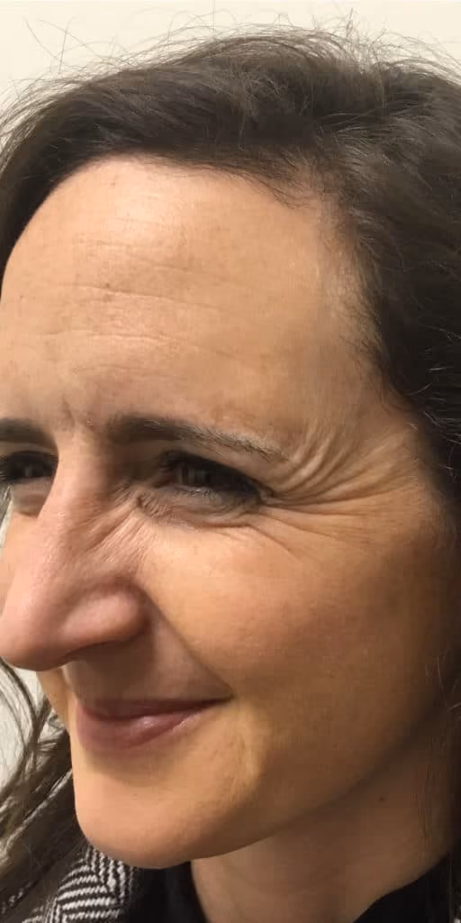 Botox before and after, Olivia Salmen, case 9740 - Cool Springs Plastic Surgery