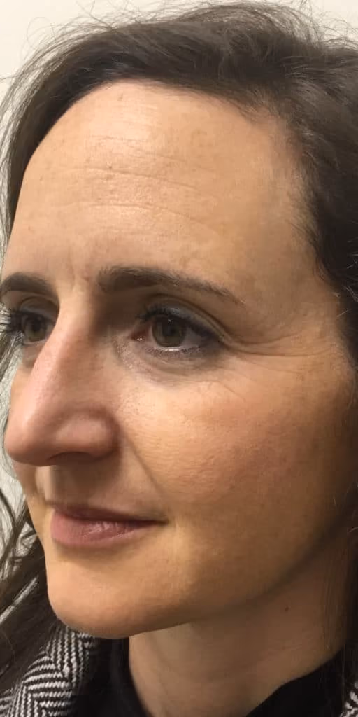 Botox before and after, Olivia Salmen, case 9740 - Cool Springs Plastic Surgery