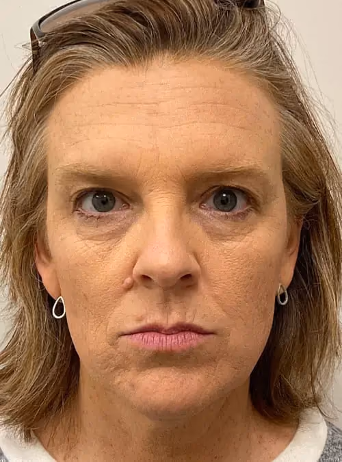 Botox before and after, Olivia Gibson, case 11558 - Cool Springs Plastic Surgery