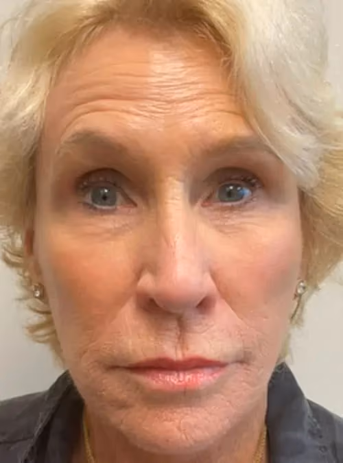 Botox before and after, Olivia Gibson, case 11566 - Cool Springs Plastic Surgery