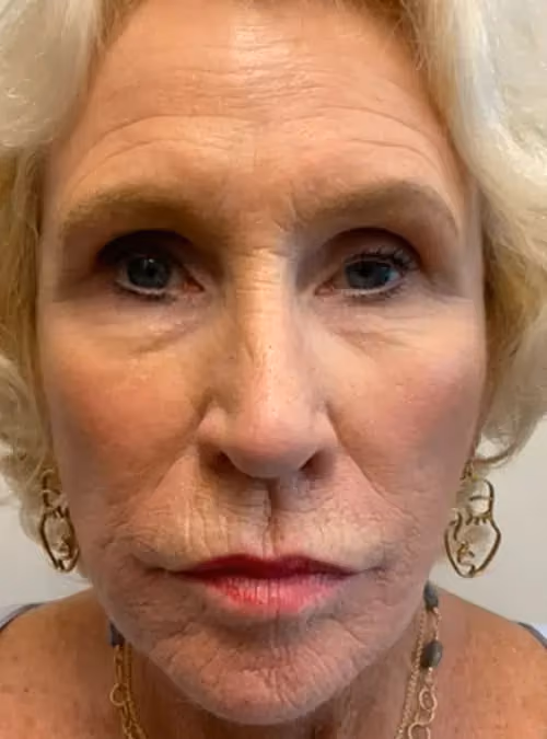 Botox before and after, Olivia Gibson, case 11566 - Cool Springs Plastic Surgery