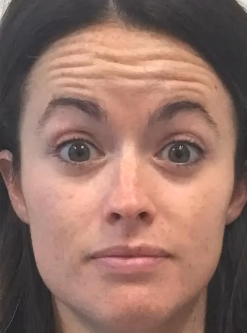 Botox before and after, Olivia Gibson, case 11596 - Cool Springs Plastic Surgery