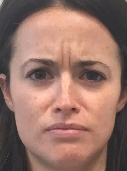 Botox before and after, Olivia Gibson, case 11596 - Cool Springs Plastic Surgery