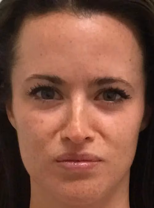Botox before and after, Olivia Gibson, case 11596 - Cool Springs Plastic Surgery