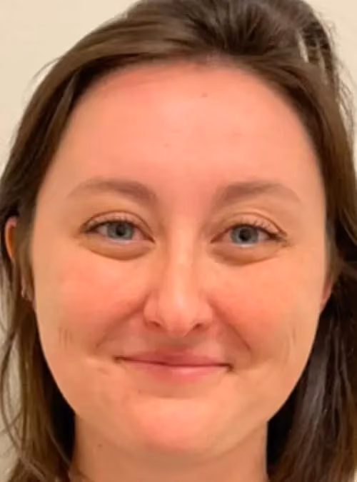 Botox before and after, Olivia Gibson, case 11640 - Cool Springs Plastic Surgery