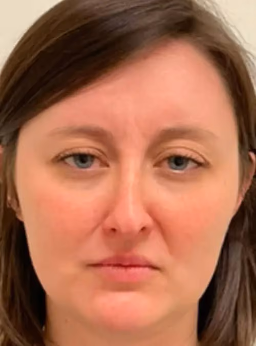 Botox before and after, Olivia Gibson, case 11640 - Cool Springs Plastic Surgery