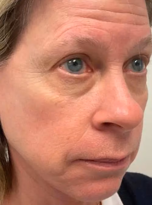 Botox before and after, Chrissy Handly, case 11685 - Cool Springs Plastic Surgery