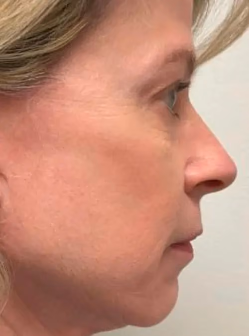 Botox before and after, Chrissy Handly, case 11685 - Cool Springs Plastic Surgery