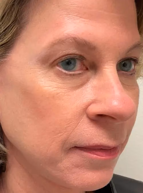 Botox before and after, Chrissy Handly, case 11685 - Cool Springs Plastic Surgery