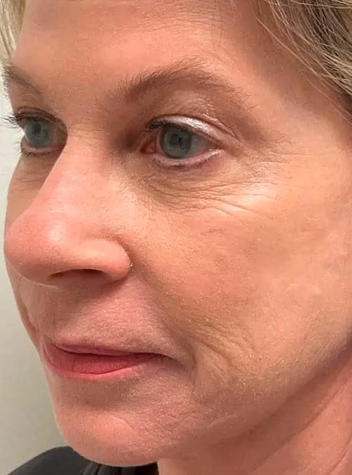 Botox before and after, Chrissy Handly, case 11685 - Cool Springs Plastic Surgery