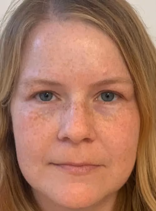 Botox before and after, Teresa Safford, case 11707 - Cool Springs Plastic Surgery