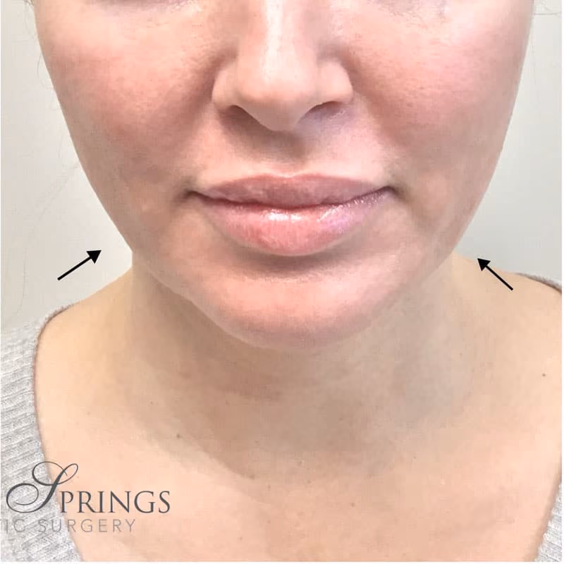 Botox before and after, Olivia Salmen, case 11710 - Cool Springs Plastic Surgery