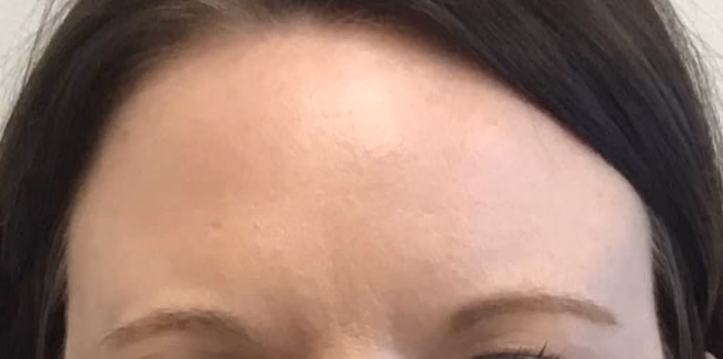 Botox before and after, case 11716 - Cool Springs Plastic Surgery