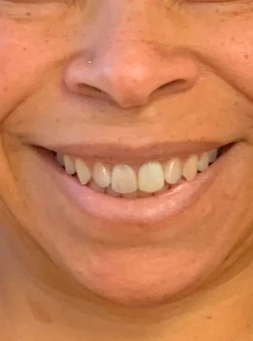 Botox before and after, Teresa Safford, case 11717 - Cool Springs Plastic Surgery