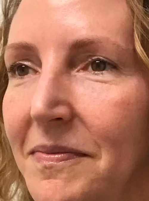 Botox before and after, case 11723 - Cool Springs Plastic Surgery