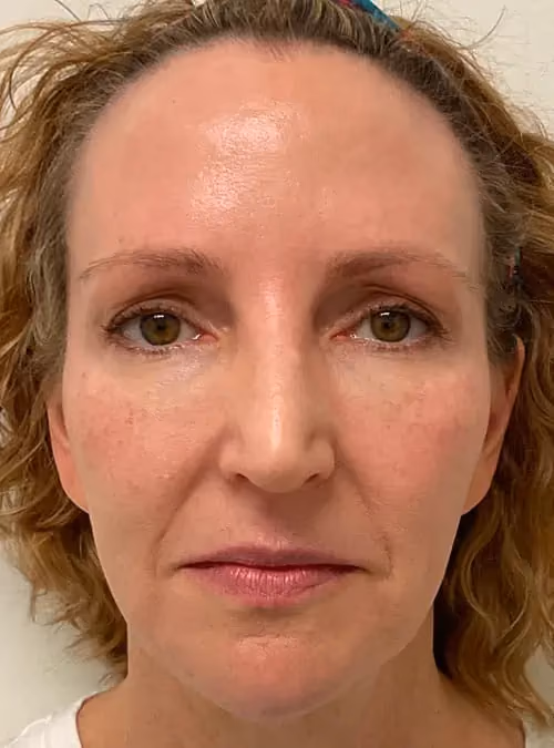 Botox before and after, case 11723 - Cool Springs Plastic Surgery