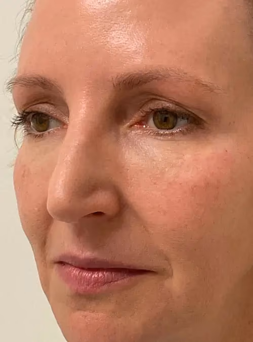 Botox before and after, case 11723 - Cool Springs Plastic Surgery