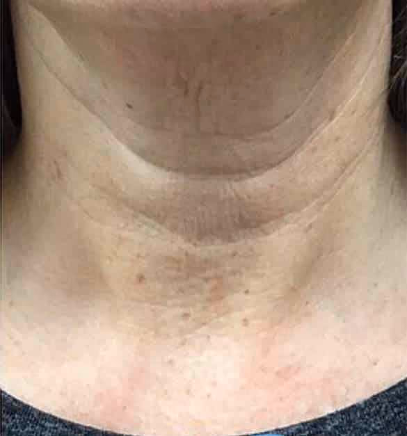 Botox before and after, case 11768 - Cool Springs Plastic Surgery