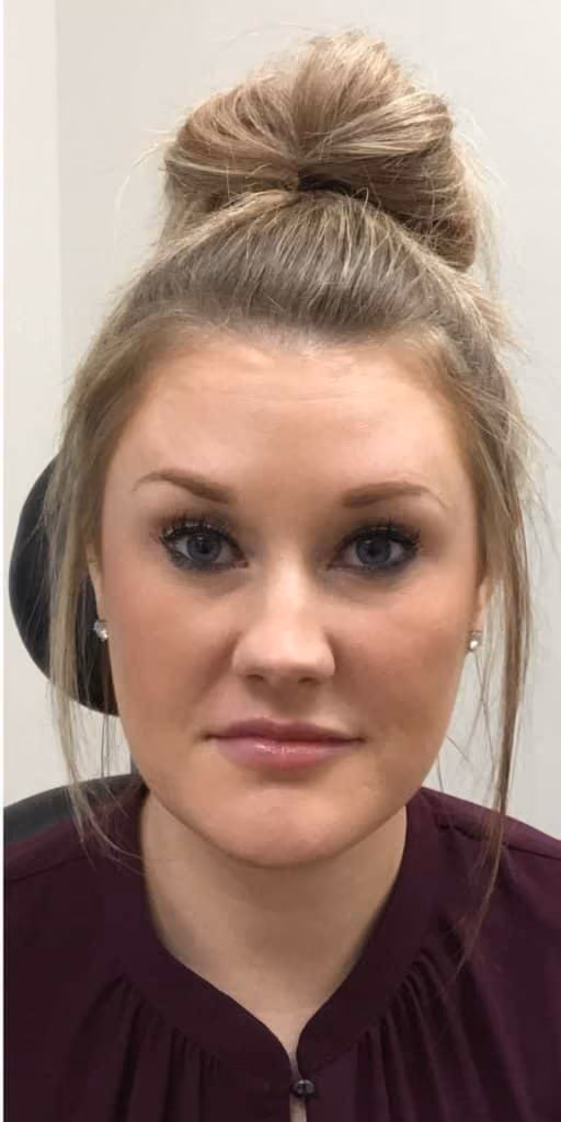 Botox before and after, case 11881 - Cool Springs Plastic Surgery