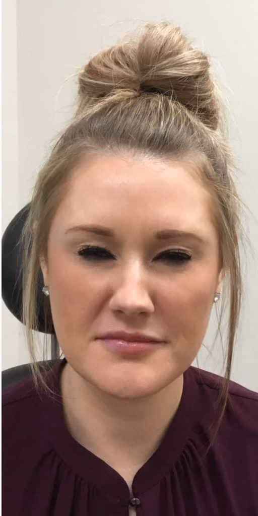 Botox before and after, case 11881 - Cool Springs Plastic Surgery