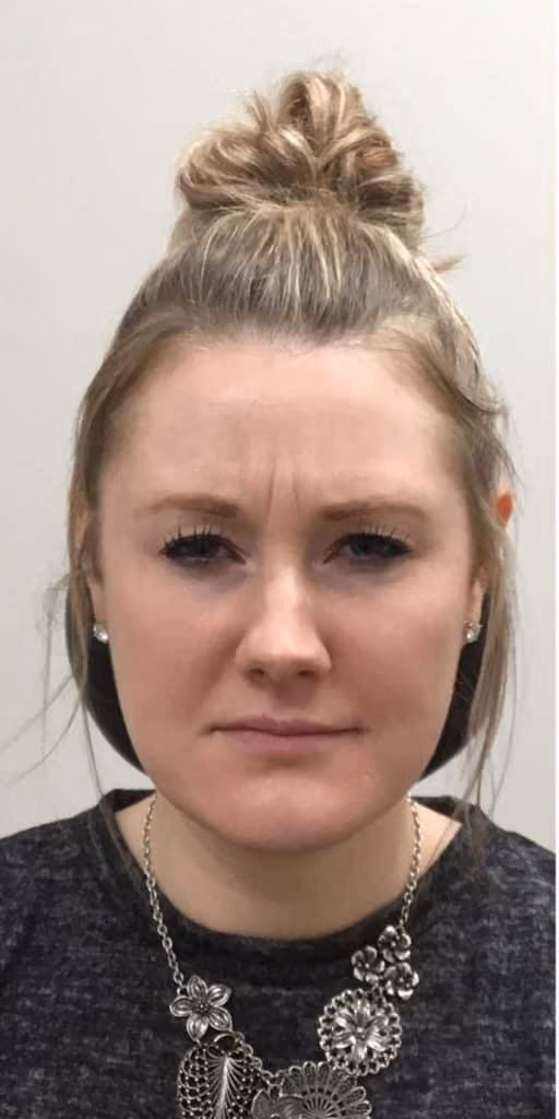Botox before and after, case 11881 - Cool Springs Plastic Surgery
