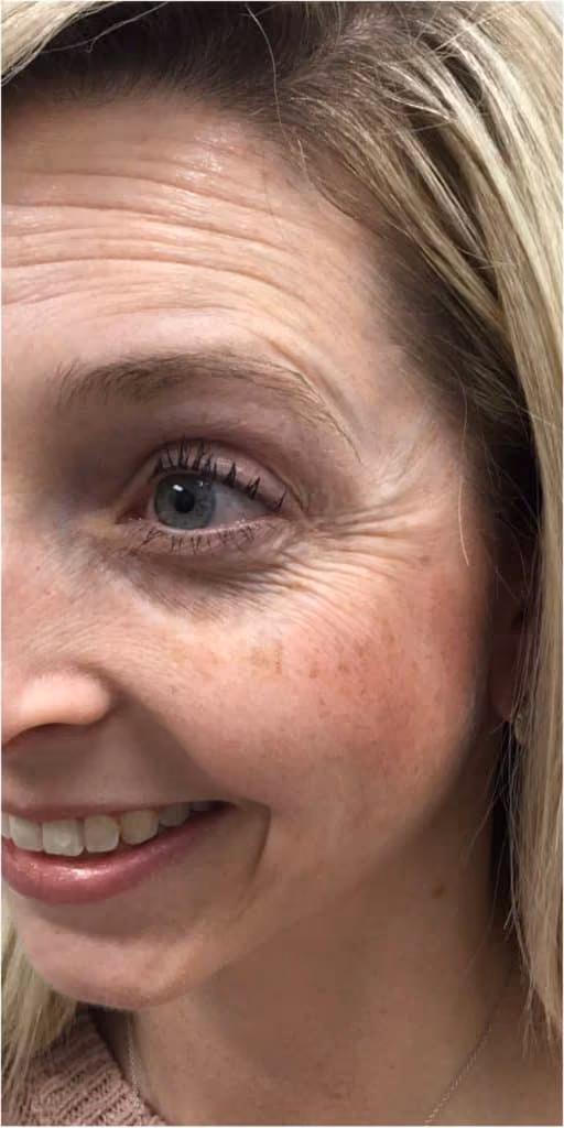 Botox before and after, Olivia Salmen, case 11993 - Cool Springs Plastic Surgery