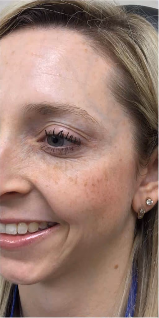 Botox before and after, Olivia Salmen, case 11993 - Cool Springs Plastic Surgery