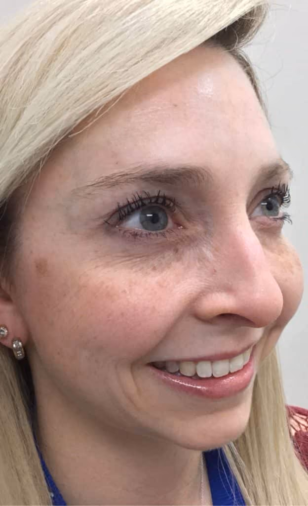 Botox before and after, Olivia Salmen, case 11993 - Cool Springs Plastic Surgery