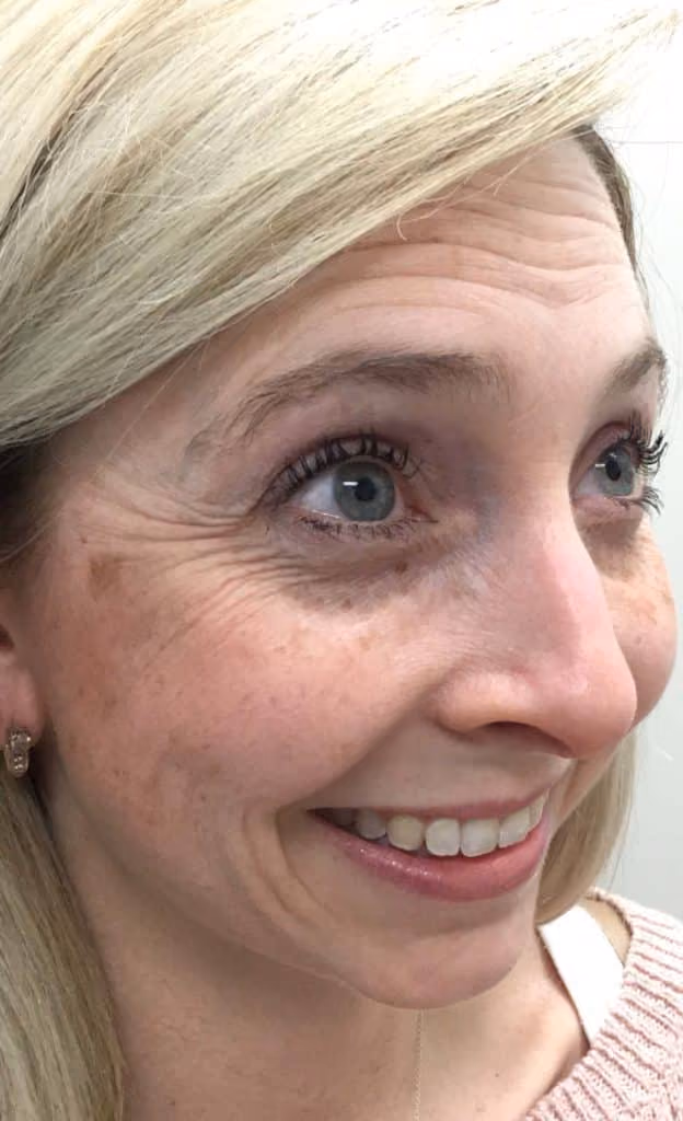 Botox before and after, Olivia Salmen, case 11993 - Cool Springs Plastic Surgery