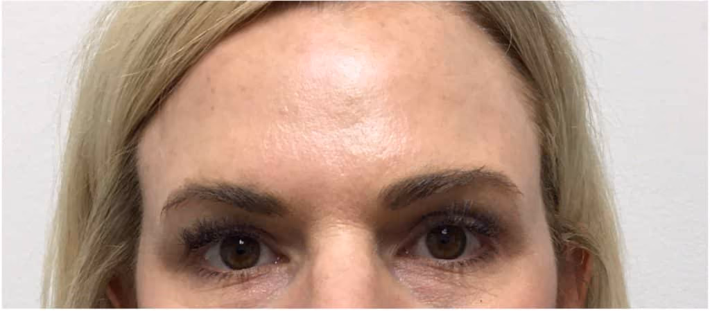 Botox before and after, Olivia Salmen, case 12023 - Cool Springs Plastic Surgery