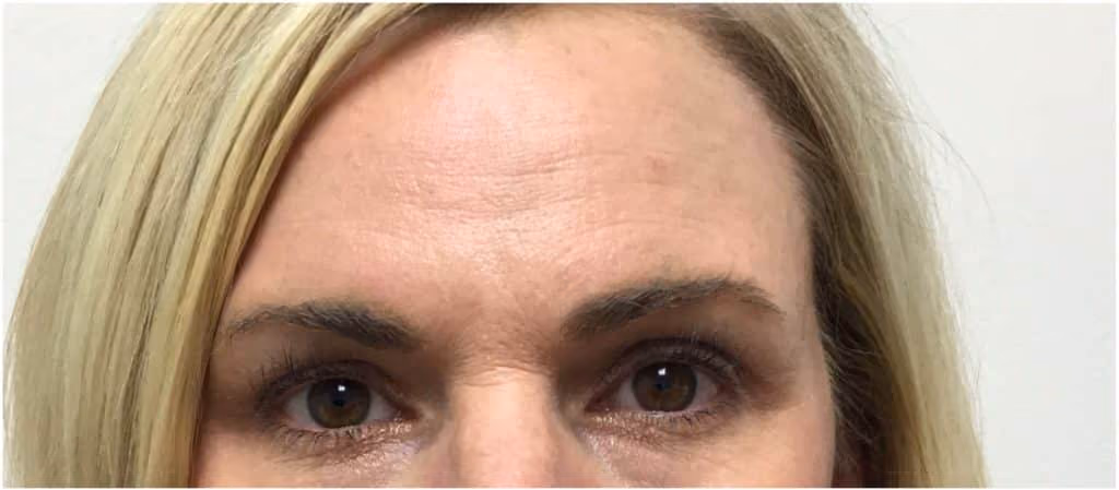 Botox before and after, Olivia Salmen, case 12023 - Cool Springs Plastic Surgery