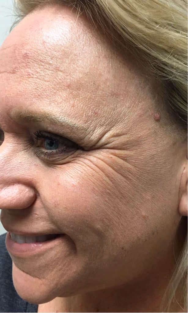 Botox before and after, Olivia Salmen, case 12059 - Cool Springs Plastic Surgery