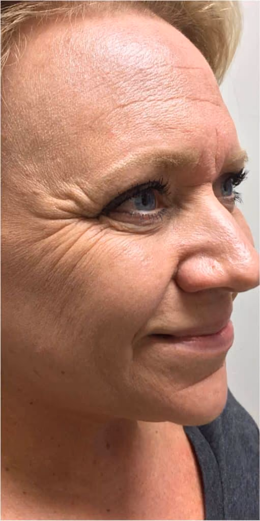 Botox before and after, Olivia Salmen, case 12059 - Cool Springs Plastic Surgery