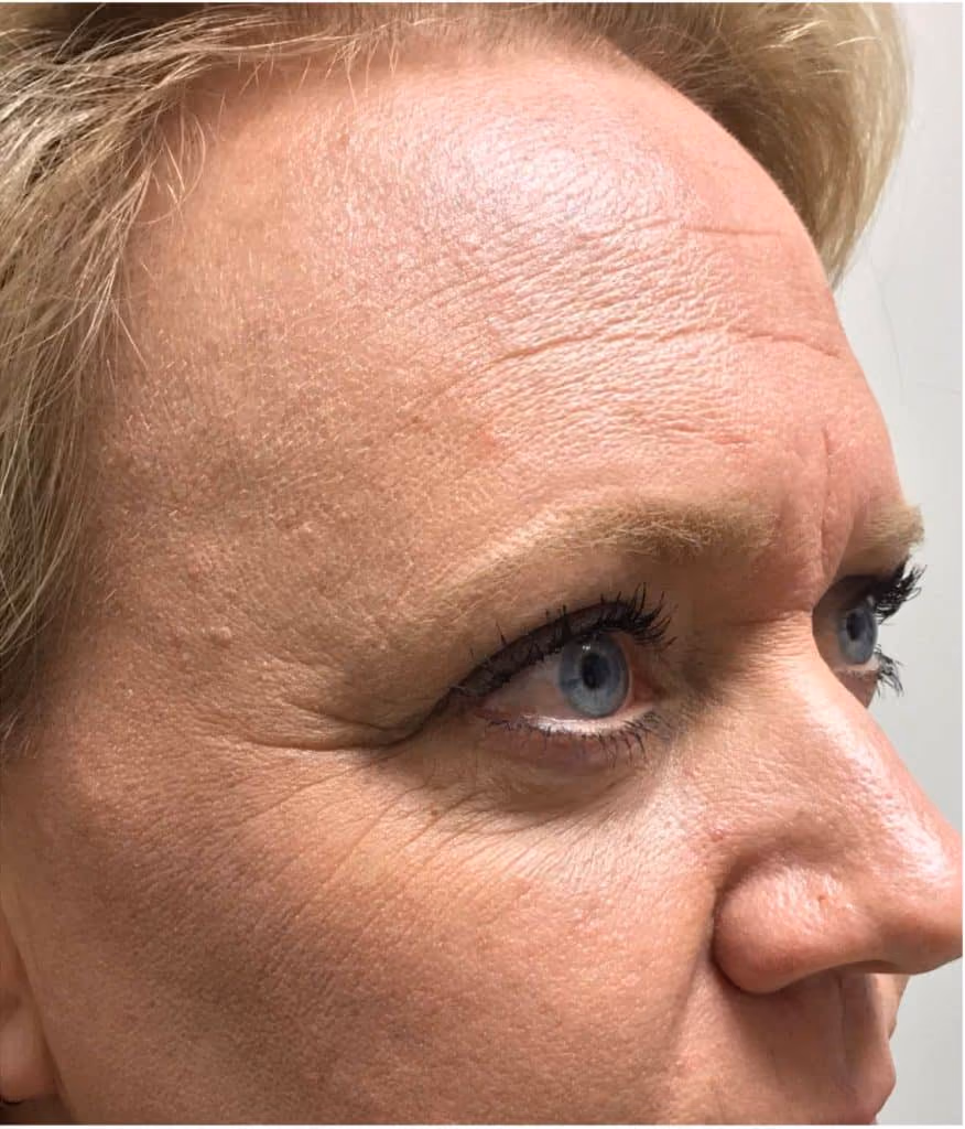 Botox before and after, Olivia Salmen, case 12059 - Cool Springs Plastic Surgery