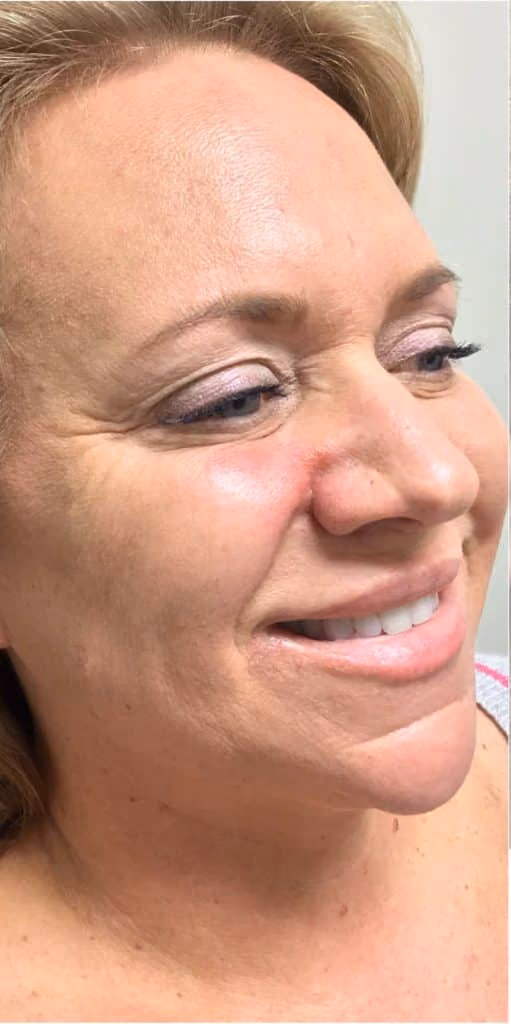 Botox before and after, Olivia Salmen, case 12059 - Cool Springs Plastic Surgery