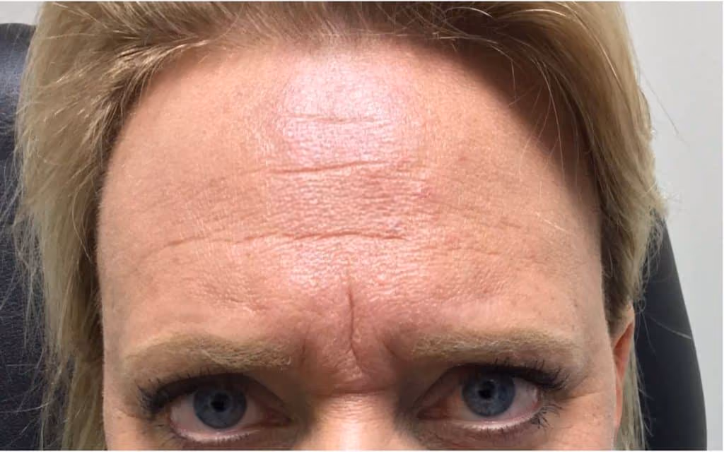 Botox before and after, Olivia Salmen, case 12059 - Cool Springs Plastic Surgery