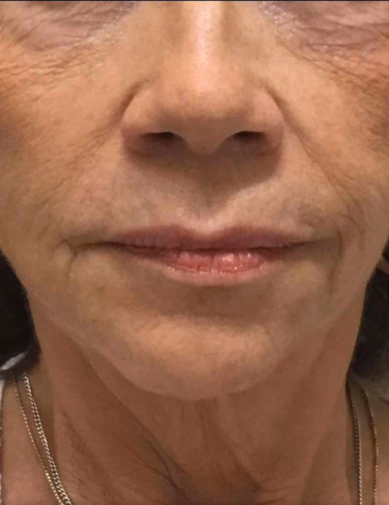 Botox before and after, case 12070 - Cool Springs Plastic Surgery