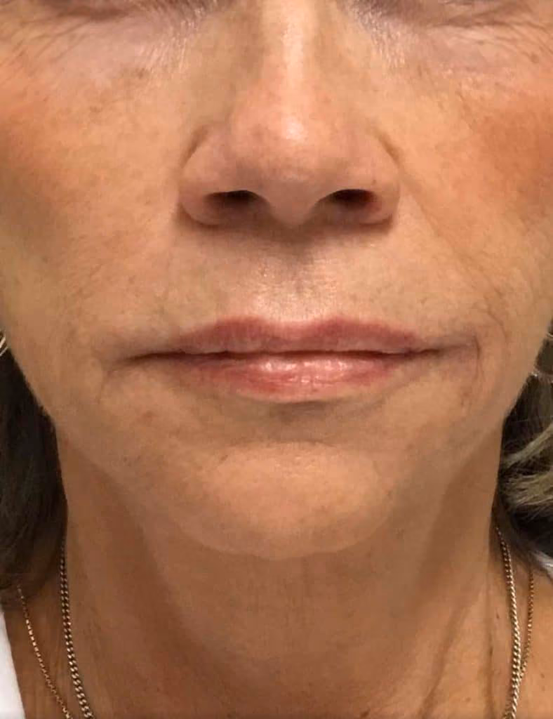 Botox before and after, case 12070 - Cool Springs Plastic Surgery