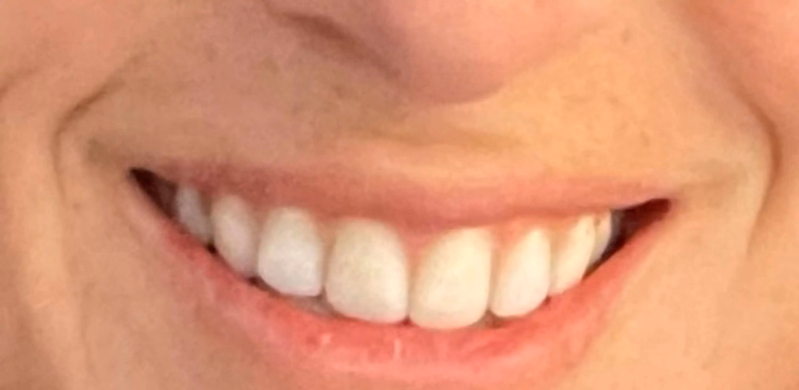 Botox before and after, Teresa Safford, case 12263 - Cool Springs Plastic Surgery