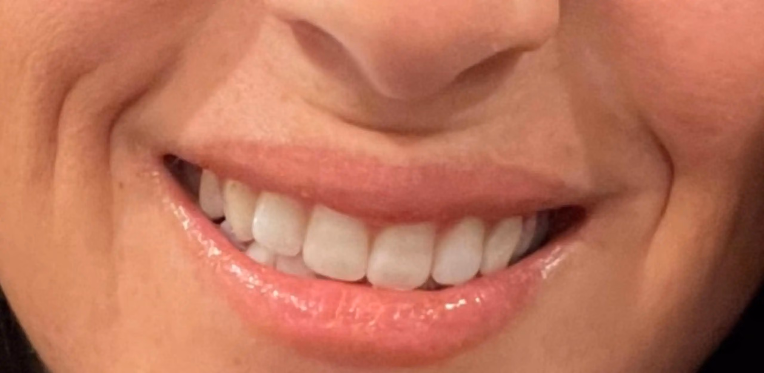 Botox before and after, Teresa Safford, case 12263 - Cool Springs Plastic Surgery