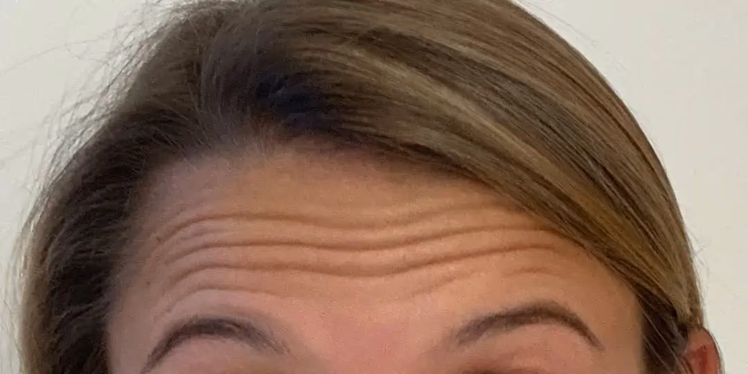 Botox before and after, Teresa Safford, case 12282 - Cool Springs Plastic Surgery