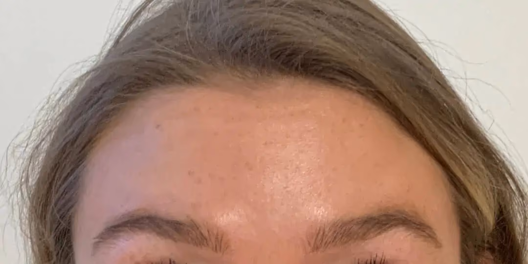 Botox before and after, Teresa Safford, case 12286 - Cool Springs Plastic Surgery