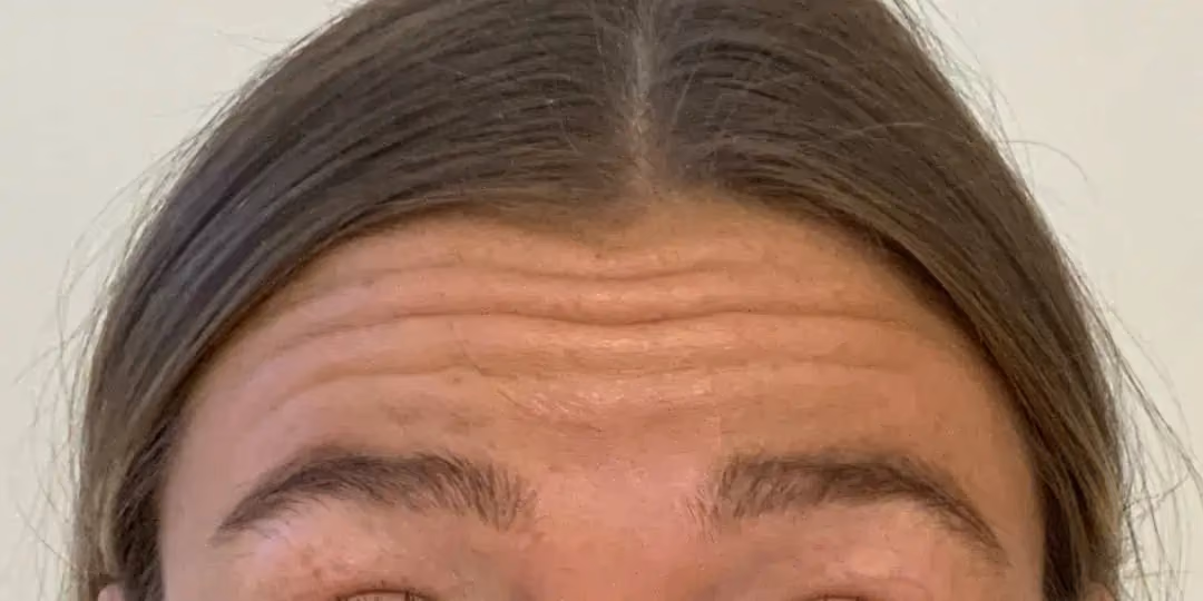 Botox before and after, Teresa Safford, case 12286 - Cool Springs Plastic Surgery