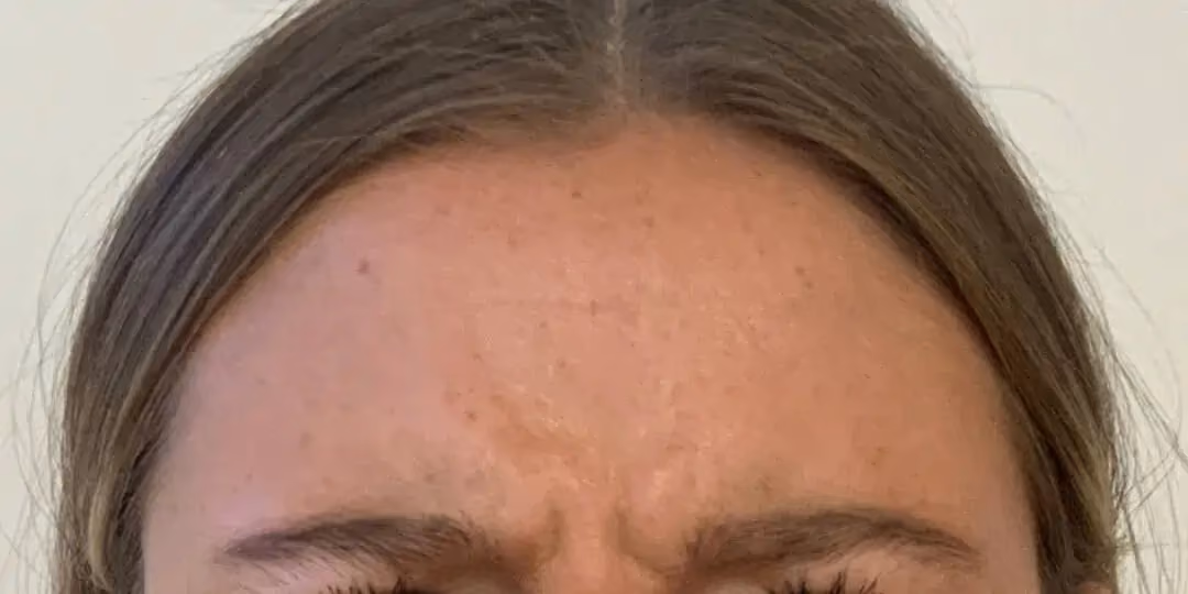 Botox before and after, Teresa Safford, case 12286 - Cool Springs Plastic Surgery
