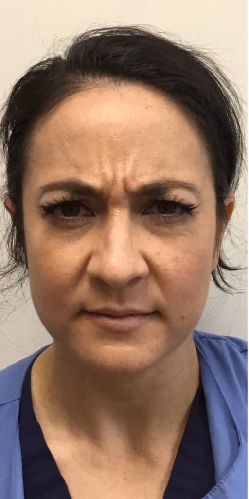 Botox before and after, case 12365 - Cool Springs Plastic Surgery