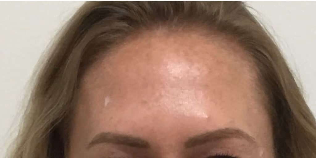 Botox before and after, case 12997 - Cool Springs Plastic Surgery