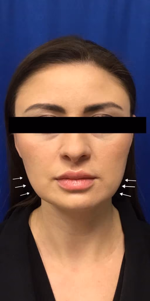 Botox before and after, case 13793 - Cool Springs Plastic Surgery