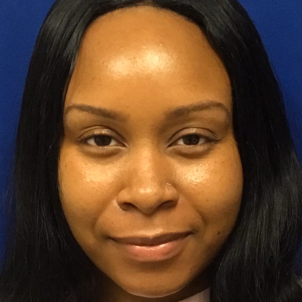 Botox before and after, case 13801 - Cool Springs Plastic Surgery