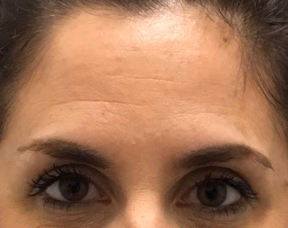 Botox before and after, case 14252 - Cool Springs Plastic Surgery